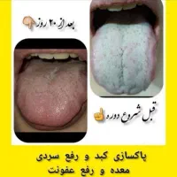 درمان و پاکسازی کبد|آرایشی، بهداشتی، درمانی|گنبد کاووس, |دیوار