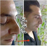 خال،فیلر،بوتاکس،انزیم،تخفیف ۵۰درصدی جشنواره ای|خدمات آرایشگری و زیبایی|کرمانشاه, |دیوار