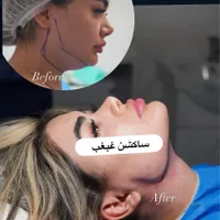 ساکشن غبغب بلفارو کاشت ابرو بوکال فت|خدمات آرایشگری و زیبایی|تهران, میرداماد|دیوار