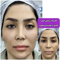 افر۷۰٪ژل گونه چانه/بوتاکس فیلربینی شقیقه/لیفت/نخ