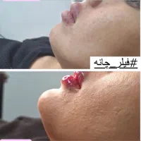 تزریق ژل وبوتاکس تخفیف ویژه|خدمات آرایشگری و زیبایی|تهران, خانی آباد نو شمالی|دیوار