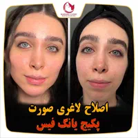 فرمدهی صورت بینی بدون جراحی بیهوشی پکیج یانگ فیس|خدمات آرایشگری و زیبایی|مشهد, هفت تیر (حافظ)|دیوار