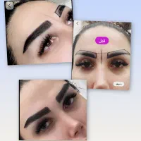 کاشت ابرو  و مو