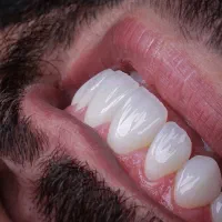 کامپوزیت لمینت روکش طلا|خدمات آرایشگری و زیبایی|تهران, شهرک چیتگر|دیوار