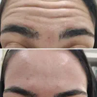 مزونیدلینگ ژل و بوتاکس|خدمات آرایشگری و زیبایی|یاسوج, |دیوار