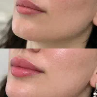 مدل فیلر لب و گونه