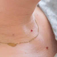 برداشتن خال و زگیل پوستی فقط 100|خدمات آرایشگری و زیبایی|محمدیه-قزوین, |دیوار