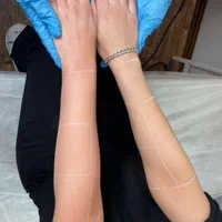 لیزر موهای زائد میکروسویچ و اپلومد کندلا وایتنینگ