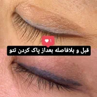 حذف تتو پاک کردن تتو بالیزر/رفع تیرگی/رفع کک و مک|خدمات آرایشگری و زیبایی|مشهد, هنرستان|دیوار
