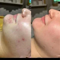 فیشال و مزونیدلینگ پوست و لیفت مژه ابرو و کاشت مژه|خدمات آرایشگری و زیبایی|تهران, تهرانپارس غربی|دیوار