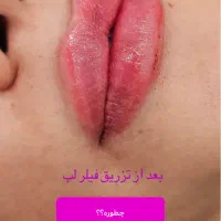 لیزرموهای زائدگلسازرشت تخفیف تااخرهفته
