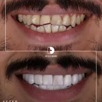 کامپوزیت دندان.لمینت|خدمات آرایشگری و زیبایی|مشهد, کوثر|دیوار