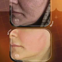 رفع اسکار و جای جوش با لیزر اربیوم