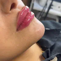 لک صورت بوتاکس خال موی سر ریش|خدمات آرایشگری و زیبایی|اهواز, کیان اباد|دیوار