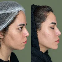 فقط تا ۸ ابان مزو فیلر بوتاکس ارزان