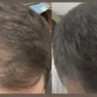 رشدو رویش مو تضمینی