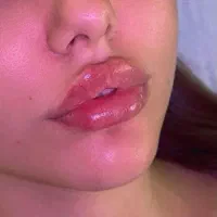 ژل و بوتاکس