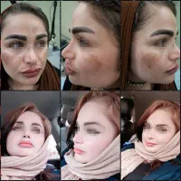 لیزر co2تک جلسه ای،تزریق چربی ودیگر خدمات زیبایی