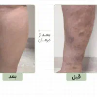 درماان تضمینی دیسک،ارتروز بصورت ریشع ای
