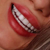 ایمپلنت ارتودنسی کامپوزیت روکش دندانپزشکی|خدمات آرایشگری و زیبایی|ماکو, |دیوار