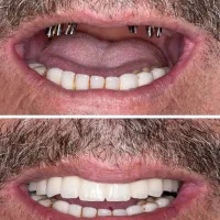 ایمپلنت  فقط 6ملیون اقساط دوساله