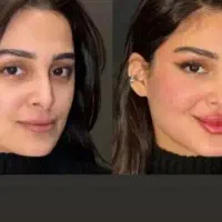 ژل بوتاکس700فول فیس با4500تومان توسط پزشک مجرب