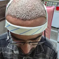 کاشت مو ابرو ریش مزوتراپی و پی آرپی جشنواره پاییزه|خدمات آرایشگری و زیبایی|اردبیل, |دیوار