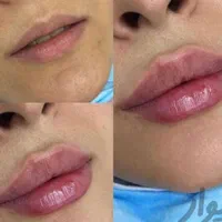 بوتاکس،تزریق ژل،مزوزیرچشم وصورت ،پرسینگ محمدشهر|خدمات آرایشگری و زیبایی|محمدشهر, محمدشهر|دیوار