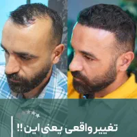 خدمات کاشت مو فقط در یک جلسه به نتیجه دلخواه برسید