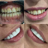 کامپوزیت دندان نانوسرامیک فکی ۸ میلیون تومان|خدمات زیبایی و سلامت|اهواز, نادری|دیوار