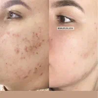 هایفوتراپی لیزر پاکسازی پلاژن روشن سازی فیشیال|خدمات آرایشگری و زیبایی|شیراز, ریاستی|دیوار