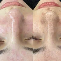 فیشیال.پاکسازی.مزو|خدمات آرایشگری و زیبایی|اهواز, کوی راه کربلا|دیوار