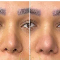 کوچک کردن بینی و رفع چین و چروک صورت