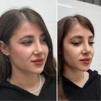 کانتورینگ صورت/فیلربوتاکس/جوانسازی/سابسیژن/ولیعصر