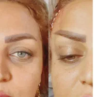 عمل لیفت ابرو وشقیقه جراحی ۸م بوتاکس مصپورت ۶۰۰|خدمات آرایشگری و زیبایی|مشهد, شهید فرامرز عباسی|دیوار