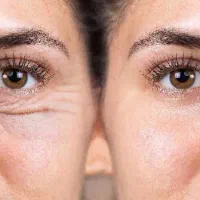 ضد لک جوان کننده|آرایشی، بهداشتی، درمانی|میاندوآب, |دیوار