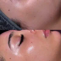 فیشیال،پاکسازی،درما پلنینگ|خدمات آرایشگری و زیبایی|بیرجند, |دیوار