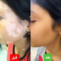 درمان پیسی وپسو ریازیس واگزما دائمی|خدمات آرایشگری و زیبایی|سمنان, |دیوار