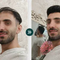 جشنواره کاشت مو