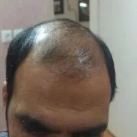 پروتز و ترمیم موی افشان|خدمات آرایشگری و زیبایی|مشهد, کوثر|دیوار