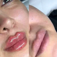 تزریق ژل و بوتاکس، حجامت