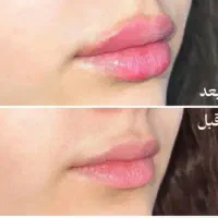 مدل ژل/فیلر لب|خدمات آرایشگری و زیبایی|تهران, قلهک|دیوار