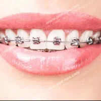 دندانپزشکی تخصصی ارتودنسی(مرتب کردن دندان ها) قسطی|خدمات آرایشگری و زیبایی|اهواز, شهرک حفاری|دیوار