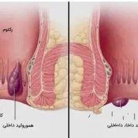 بواسیر شقاق یبوست|آرایشی، بهداشتی، درمانی|میاندوآب, |دیوار