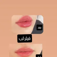 تزریق ژل با قیمت مناسب وبا کیفیت|خدمات آرایشگری و زیبایی|برازجان, |دیوار