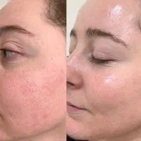 کرم حلزون درمان لک جوش قدیمی وسفیدکننده دقیق بخون