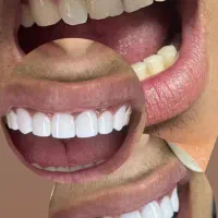 جشنواره کامپوزیت دندان|خدمات آرایشگری و زیبایی|شاهرود, |دیوار