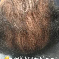 میکرواسکالپ / اسکالپ جایگزین کاشت مو تضمینی|خدمات آرایشگری و زیبایی|مشهد, شهید فرامرز عباسی|دیوار