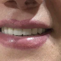 دندانسازی ساخت دندان مصنوعی ژله ای