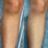افتتاحیه لیزرموتخفیف ویژه به مدت سه روز ۵۰درصد|خدمات زیبایی و سلامت|اهواز, کیانپارس |دیوار